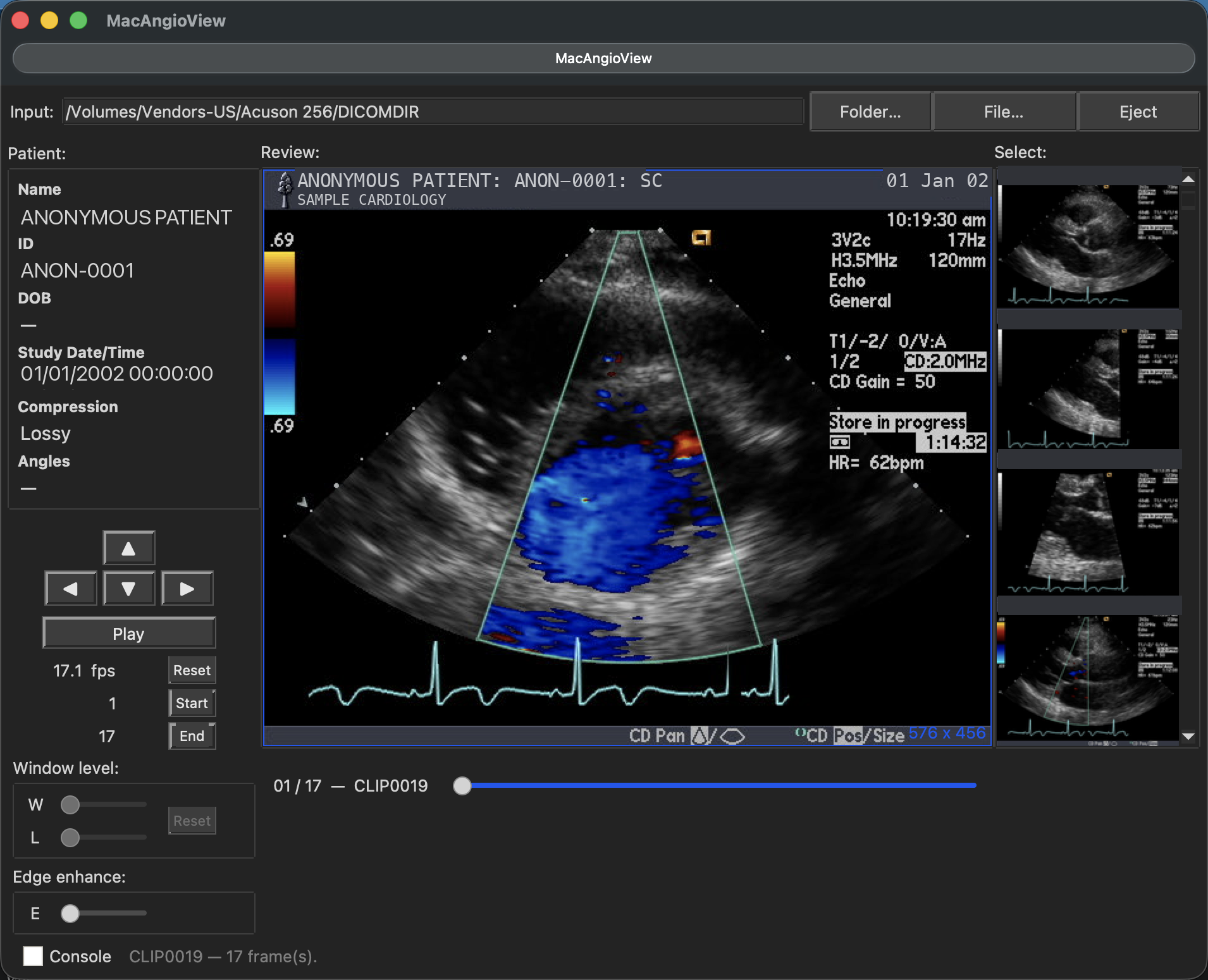MacAngioView playing a color-Doppler echocardiography (ultrasound) loop, with study thumbnails, frame slider, edge-enhance and window-level controls