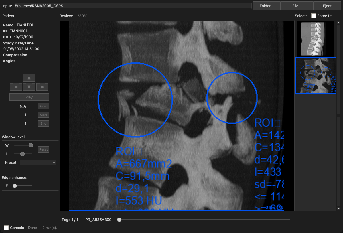 MacAngioView rendering a Grayscale Softcopy Presentation State: a CT spine image with two circular regions of interest and their measurements