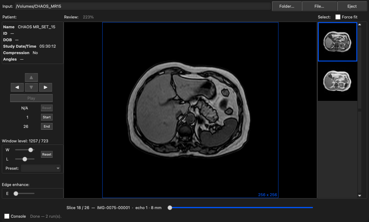 MacAngioView showing a dual-echo abdominal MR series split into two stacks, one per echo, with echo 1 displayed