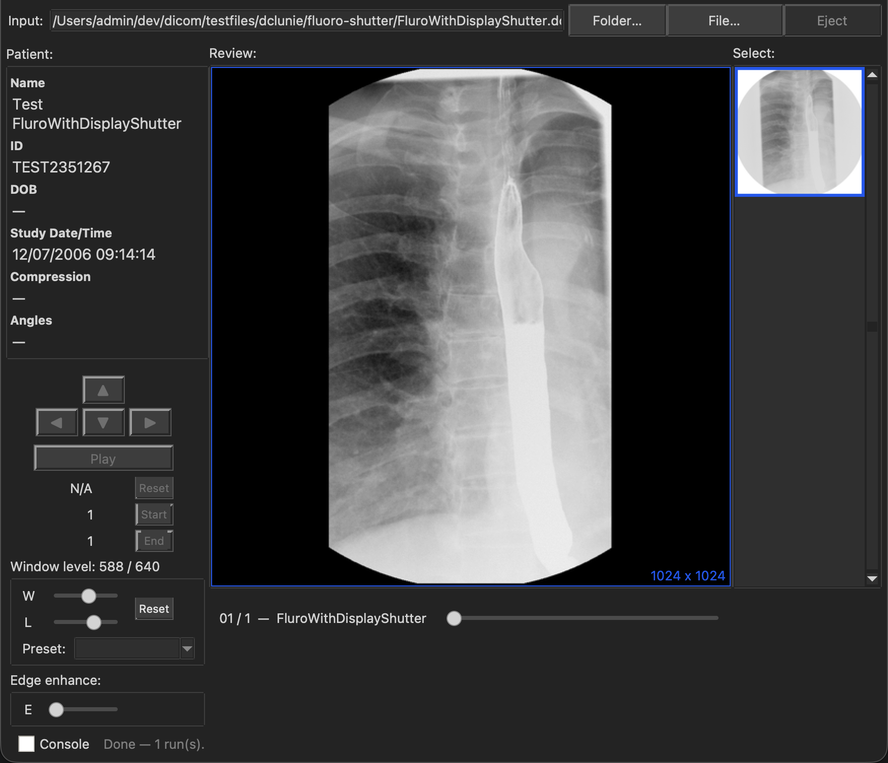 MacAngioView displaying a real radiofluoroscopic (RF) chest study with a Display Shutter applied