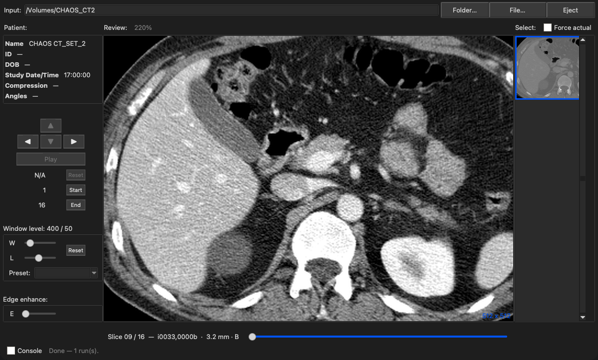MacAngioView showing an abdominal CT slice magnified to 220 percent, roamed to the liver, pancreas and kidneys