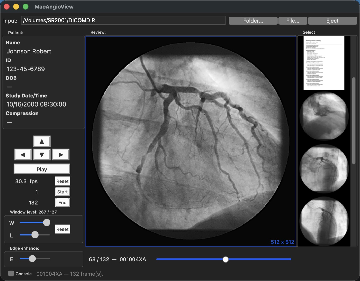 MacAngioView on macOS playing a coronary cine-angiogram run at 30 fps, with run thumbnails including a structured report, frame slider, and window-level controls